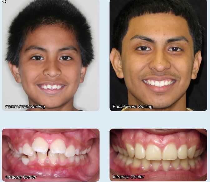 Before and After - Rodriguez Orthodontics