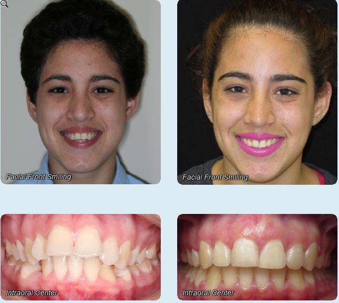 Before and After - Rodriguez Orthodontics