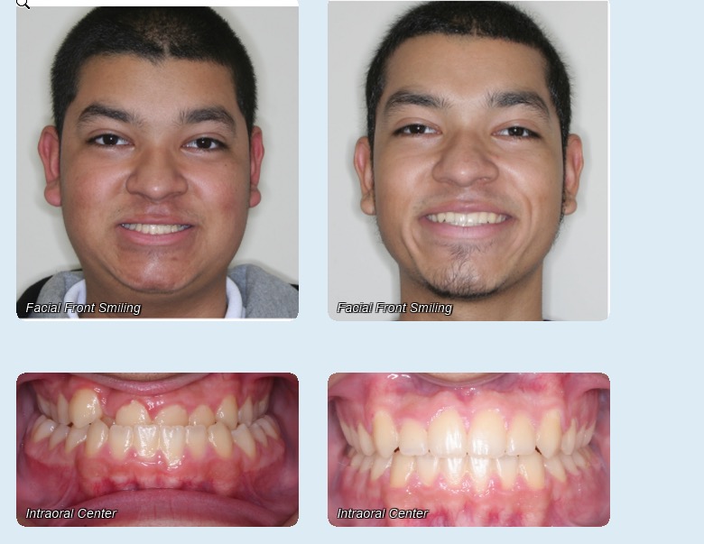 Before and After - Rodriguez Orthodontics