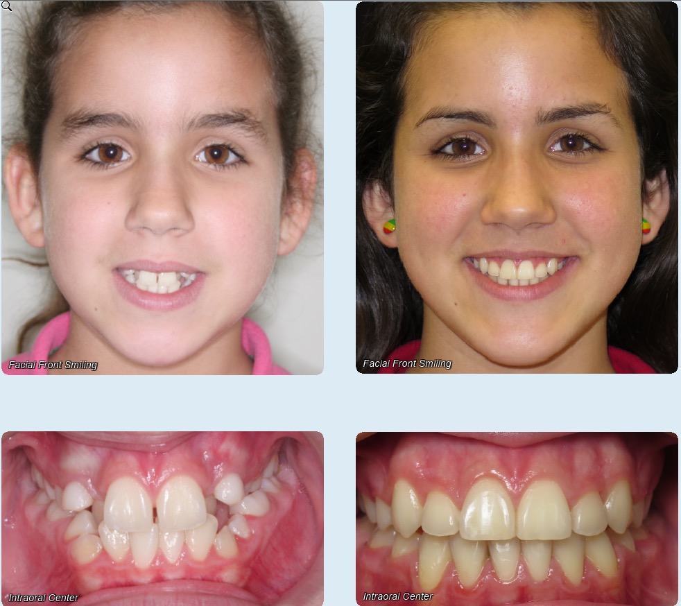 overbite before and after