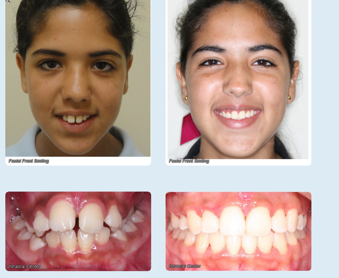 Before and After - Rodriguez Orthodontics