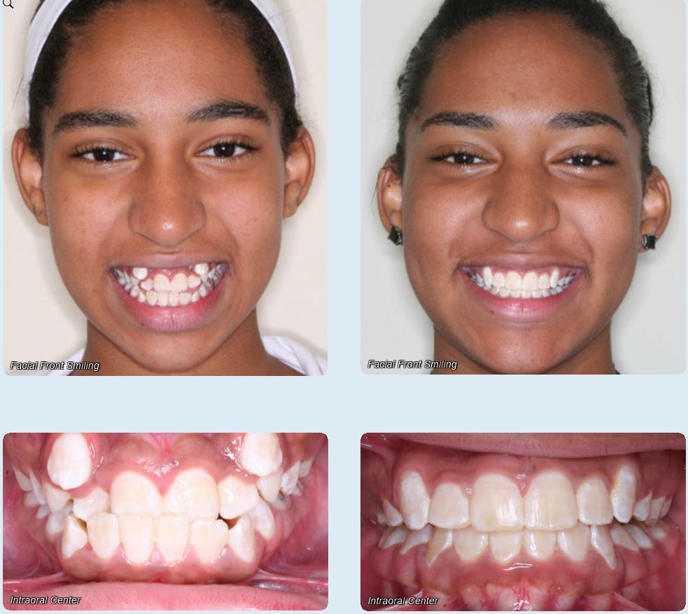 Before and After - Rodriguez Orthodontics